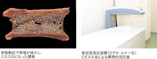 骨粗鬆症で骨塩が減少し、スカスカになった腰椎」、「骨密度測定装置(DPX:ルナ-社):DEXA法による標準的測定器」