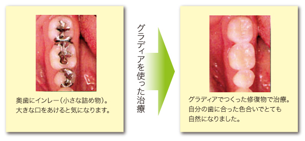グラディアを使った治療